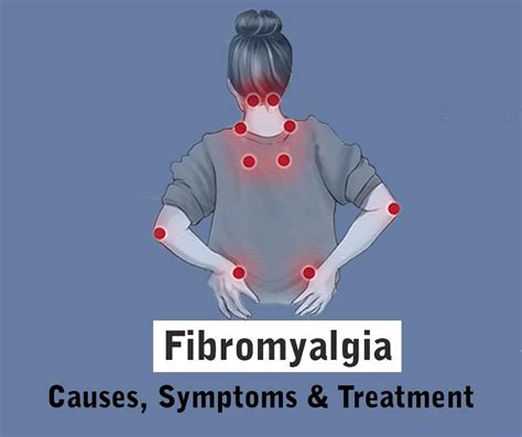 Fibromyalgia: Symptoms, Causes, Diagnosis, Treatment